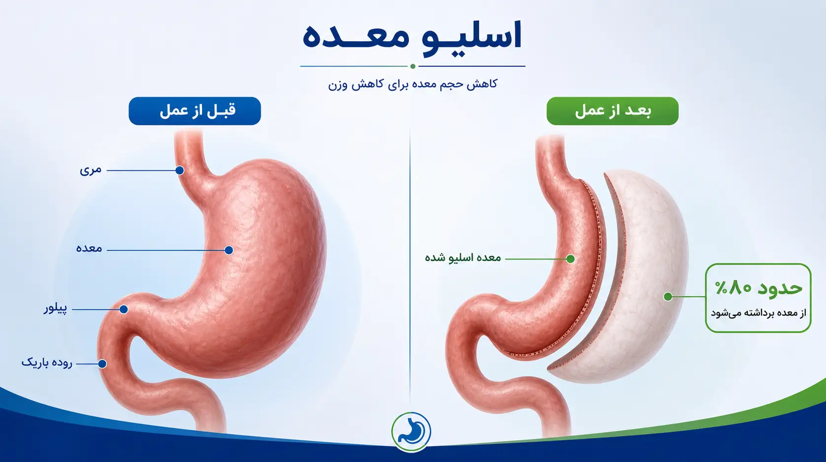 جراحی اسلیو معده - نمای شماتیک نحوه برداشتن ۸۰ درصد معده و تشکیل کیسه موزی شکل با متنهای فارسی توضیحی