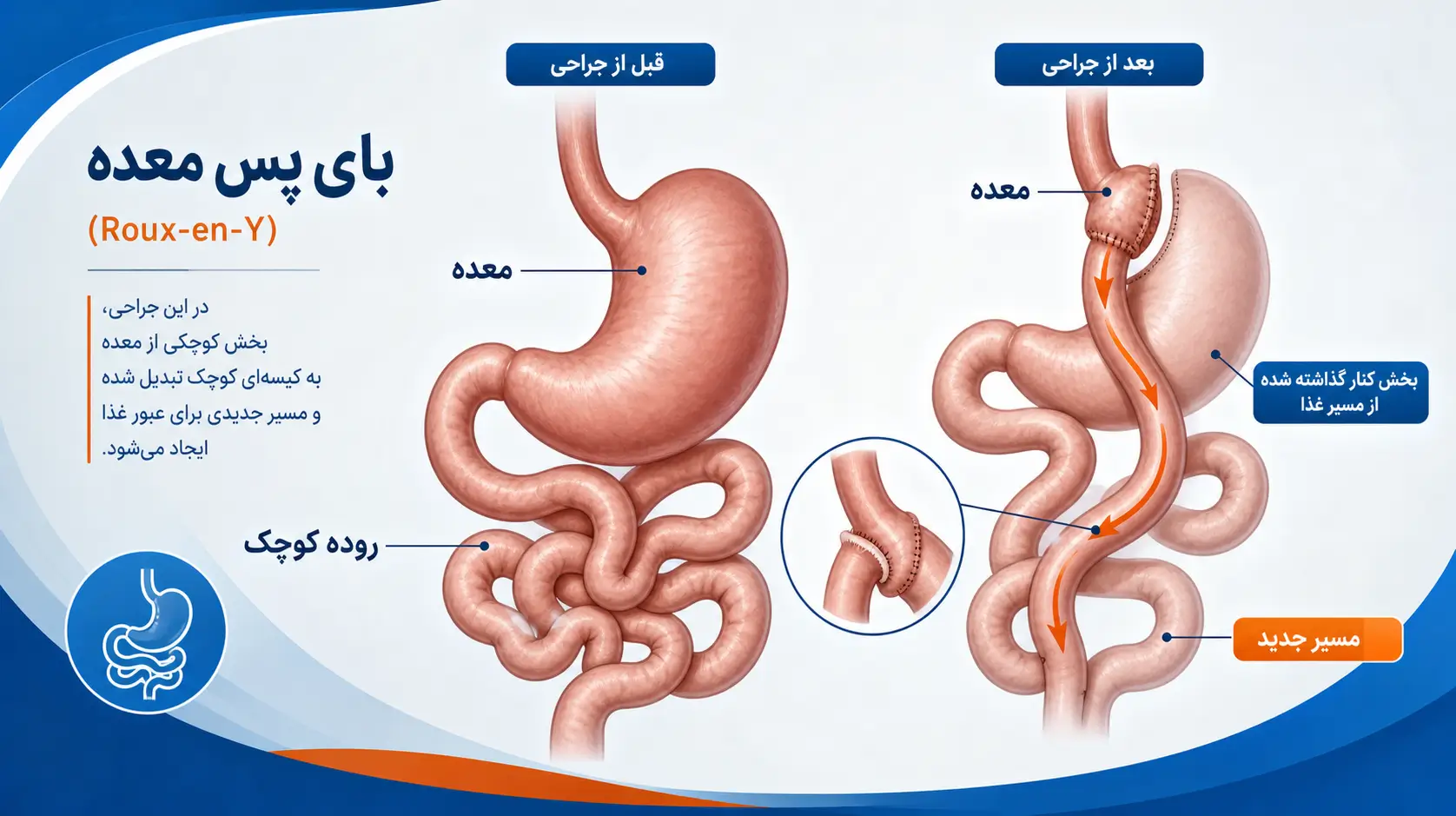 جراحی بای پس معده - نمای شماتیک تغییر مسیر روده و ایجاد کیسه معده کوچک با متنهای فارسی توضیحی