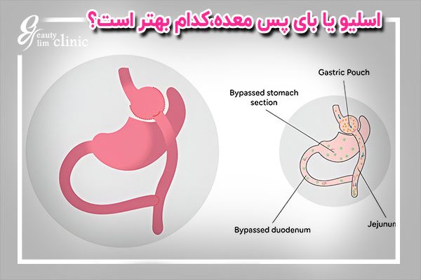 تصویر شماتیک و آموزشی از مقایسه جراحی اسلیو معده و بای پس معده، شامل تغییرات آناتومیکی و مسیر گوارشی برای درک بهتر بیماران