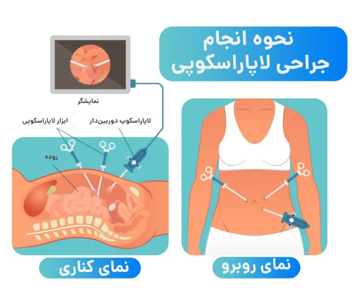 عمل لاپاراسکوپی در کلینیک اسلیم بیوتی با تیم متخصص و تجربه بالا