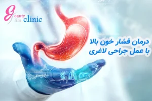 تصویری از جراحی لاغری به عنوان روشی موثر برای کاهش فشار خون بالا و بهبود سلامت بیماران مبتلا به چاقی.