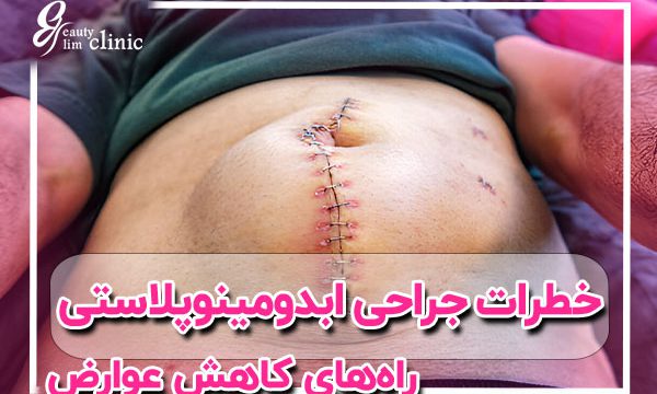 خطر مرگ بر اثر ابدومینوپلاستی: همه چیز درباره جراحی ابدو خطر مرگ بر اثر ابدومینوپلاستی یا تامی تاک، همه چیز درباره خطر مرگ جراحی ابدو، مزایا و مراقبت‌های بعد از عمل را بخوانید. راهی برای داشتن شکمی صاف و جذاب، ابدومینوپلاستی یا تامی تاک، همه چیز درباره جراحی شکم، خطرات، مزایا و مراقبت‌های بعد از عمل را در این مقاله بخوانید.