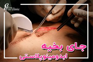 جای بخیه ابدومینوپلاستی؛ نکات طلایی برای بهبود سریع و کاهش اثرات اسکار