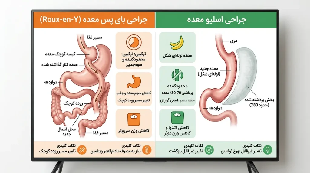 اینفوگرافیک مقایسه عمل اسلیو و بای پس معده - تفاوت های کلیدی