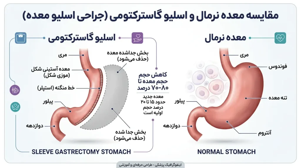 تصویر مقایسه معده قبل و بعد از عمل اسلیو - کاهش حجم معده