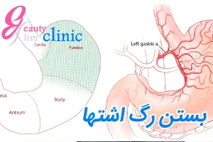بستن رگ اشتها چیست؟