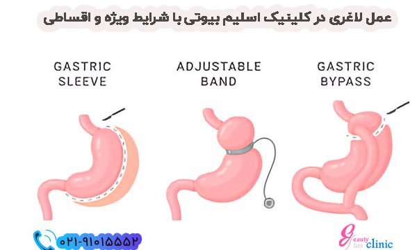 عمل لاغری در کلینیک اسلیم بیوتی با شرایط ویژه و اقساطی انواع جراحی لاغری در کلینیک اسلیم بیوتی،اسلیو معده ،بای پس، مینی بای پس، عمل لاغری قسطی و پشتیبانی کامل پس از جراحی، راهی مطمئن برای کاهش وزن و تناسب اندام شما