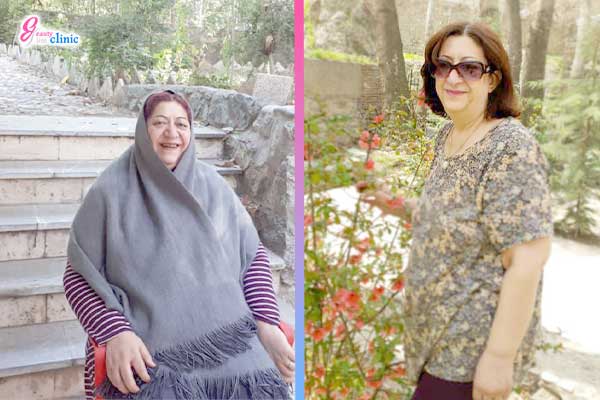مشاهده ویدیوهای تجربیات واقعی بیماران پس از جراحی‌های لاغری در کلینیک اسلیم بیوتی. نتایج شگفت‌انگیز عمل اسلیو معده و بای‌پس معده با مشاوره رایگان-تجربیات...