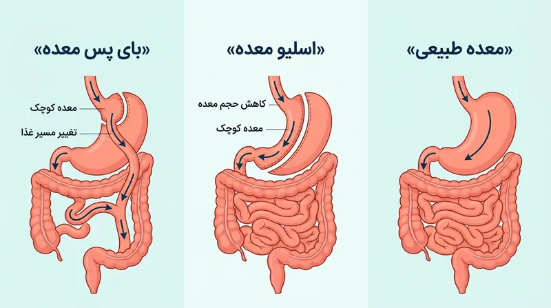 عمل کوچک کردن معده برای لاغری؛ نمایش ساده اسلیو و بای‌پس معده