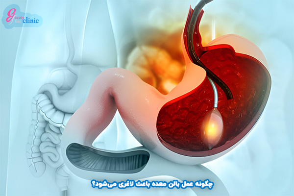 لاغری بدون جراحی با بالن معده
