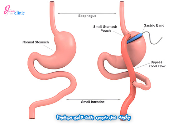 حلقه گذاری معده: کاهش وزن بدون جراحی بزرگ