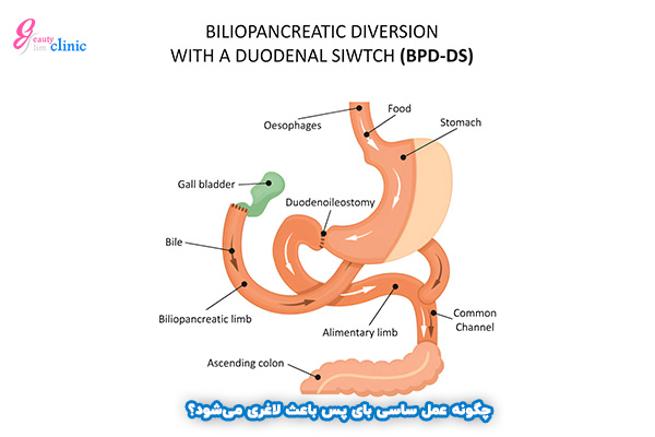 انحراف بایلی پانکراسی با دئودنال سوئیچ (BPD/DS) بای پس معده یا بایپس روده