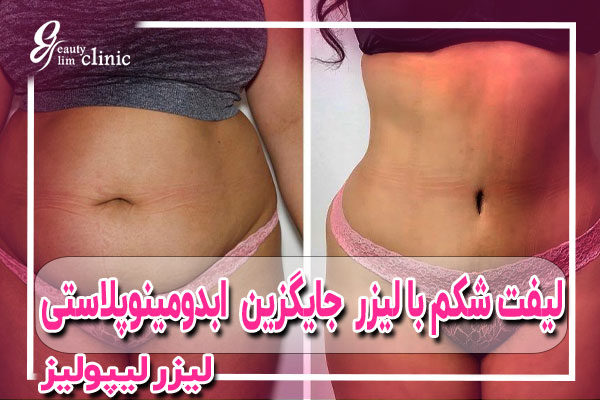 با جایگزین لیفت شکم با لیزر جراحی ابدومینوپلاستی اعتماد به نفس خود را دوباره بدست آورید. چه از بارداری، کاهش وزن یا پیری باشد، شلی پوست شکم با روش‌های مینی یا ابدومینوپلاستی کامل، همراه با اصلاح دیاستاز و لیپوساکشن قابل درمان است.