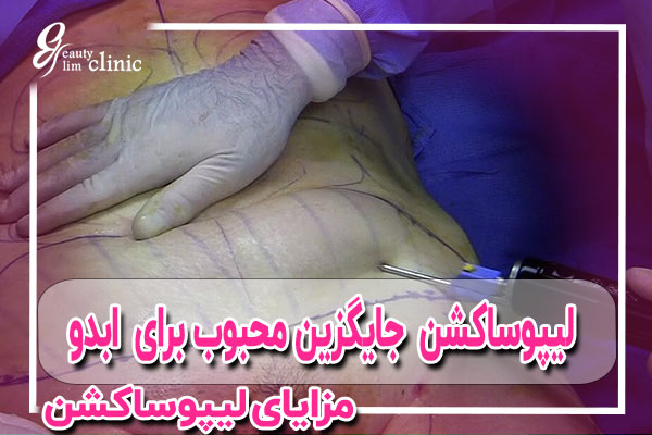 لیپوساکشن (Liposuction) – حذف چربی‌های اضافهاگر به دنبال جایگزین جراحی هستید که چربی‌های اضافه را به‌طور مؤثرتری حذف کند، لیپوساکشن یک گزینه مناسب است. این روش چربی‌های مقاوم را بدون نیاز به برداشتن پوست اضافی از بین می‌برد. مزایا: ✅ نتایج سریع‌تر نسبت به روش‌های غیرجراحی ✅ بدون ایجاد اسکارهای بزرگ ✅ امکان ترکیب با سایر روش‌های فرم‌دهی شکم