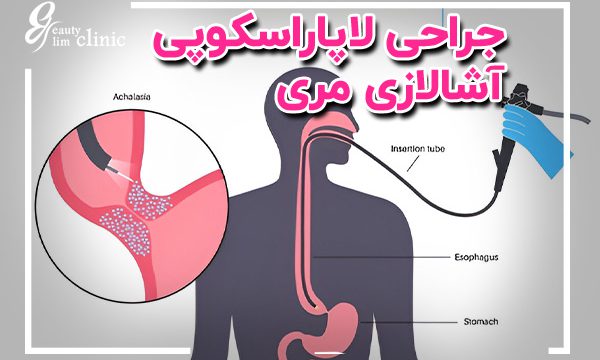 جراحی آشالازی مری: بهترین روش درمان و مزایای لاپاراسکوپی آشالازی مری یک اختلال بلع است. در این مقاله با علائم، جراحی لاپاراسکوپی و روش‌های درمانی آن آشنا شوید. همچنین مشاوره رایگان در کلینیک اسلیم بیوتی.