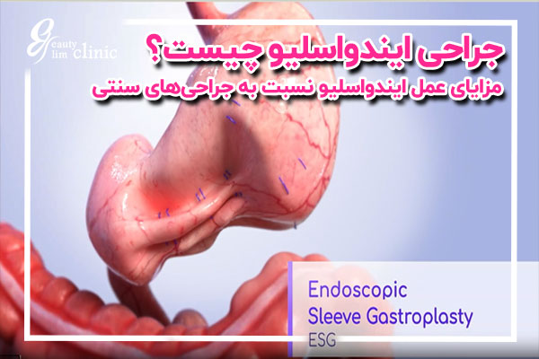 📌عمل ایندواسلیو: جدیدترین روش کاهش حجم معده برای کاهش وزن ✅عمل ایندواسلیو جدیدترین روش کمتهاجمی کاهش حجم معده که بدون جراحی سنتی به کاهش وزن کمک میکند. روشی ایمن و موثر برای درمان چاقی.مشاوره رایگان کلینیک اسلیم...
