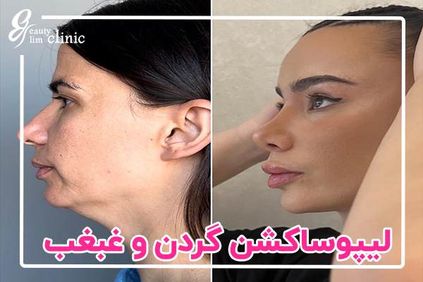 عمل لیپوماتیک غبغب راهی مؤثر برای از بین بردن چربیهای اضافه زیر چانه و داشتن چهرهای زیباتر و جوانتر است. در این مقاله با مزایا، عوارض و مراقبتهای بعد از جراحی لیپوماتیک غبغب آشنا شوید.