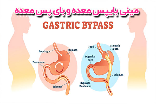 آیا بای‌پس معده و مینی بای‌پس معده برای همه افراد مناسب هستند؟ نه، بای‌پس معده و مینی بای‌پس معده برای همه افراد مناسب نیستند. این دو روش جراحی چاقی به‌طور معمول برای افرادی که با مشکلات چاقی روبه‌رو هستند و نتوانسته‌اند با استفاده از روش‌های غیرجراحی مانند تغییرات رژیم غذایی و ورزش، کاهش وزن مؤثری داشته باشند، استفاده می‌شود. انتخاب اینکه کدام روش جراحی مناسب است، باید با توجه به وضعیت و نیازهای هر فرد توسط تیم پزشکی متخصص اتخاذ شود.