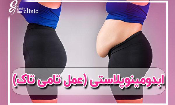 ابدومینوپلاستی: برای فرم‌دهی شکم و از بین بردن چربی اضافی 🎯ابدومینوپلاستی (عمل تامی تاک) در کلینیک اسلیم بیوتی، روشی مؤثر برای فرم‌دهی شکم و حذف پوست اضافی. با تیم متخصص و تجربه‌ای ایمن و موفق، و نتیجه دلخواه خود