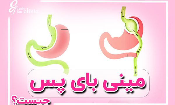 تصویر جراحی مینی بای پس معده در کلینیک اسلیم بیوتی؛ با تیم متخصص برای کاهش وزن مؤثر