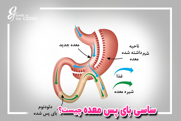 ساسج بایپسSASJ Bypassچیست؟مقایسه با اسلیو، بای پس+کاندیدها ✅ساسج بایپس (SASJ Bypass) یک روش جراحی نوین برای کاهش وزن است که ترکیبی از اسلیو معده و بایپس معده است.مقایسه با بایپس و اسلیو و کاندیدها، جراح متخصص ساسج بایپس ویرایش Snippet