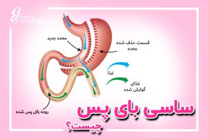 ساسج بایپسSASJ Bypassچیست؟مقایسه با اسلیو، بای پس+کاندیدها