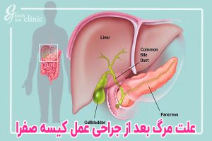 عوارض برداشتن کیسه صفرا و علت مرگ بعد از عمل کیسه صفرا چیست؟ در این مقاله به بررسی عوارض احتمالی برداشتن کیسه صفرا و علل نادر مرگ پس از عمل جراحی کیسه صفرا می‌پردازیم. اطلاعات کامل درباره کوله‌سیستکتومی و خطرات آن را... عوارض جانبی و خطرات جراحی کیسه صفرا: نکات مهم برای آگاهی بیشت