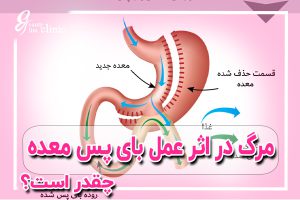 🎯 مرگ در اثر عمل بای‌ پس معده چقدر است؟+پیشگیریهای قبل عمل 📌مرگ در اثر عمل بای‌پس معده چقدر است؟پیشگیری‌های قبل از عمل. در این مقاله به بررسی درصد احتمال مرگ در اثر عمل بای‌پس معده و اقدامات پیشگیرانه برای کاهش خطرات