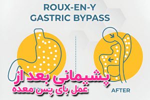 برای جلوگیری از پشیمانی بعد از عمل بای پس معده، انتخاب جراح مجرب و رعایت دقیق دستورات پزشک، مراقبت‌های بعد از عمل و پیگیری رژیم غذایی و فعالیت بدنی بسیار اهمیت دارد.