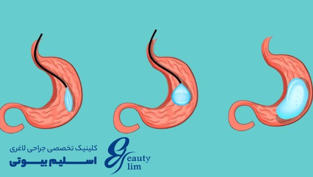 مراحل بالن معده