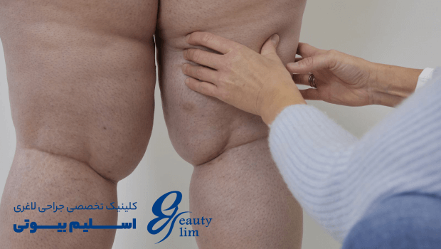 علائم لیپیدما