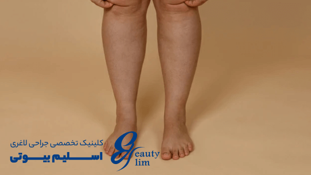 تشخیص لیپیدما