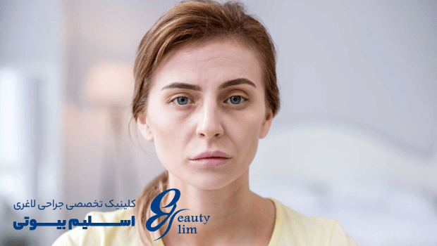 لاغری صورت بعد از اسلیو معده
