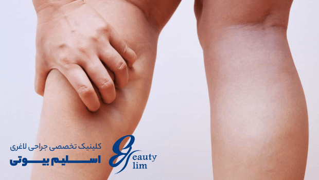 درد پا بعد از عمل جراحی اسلیو معده