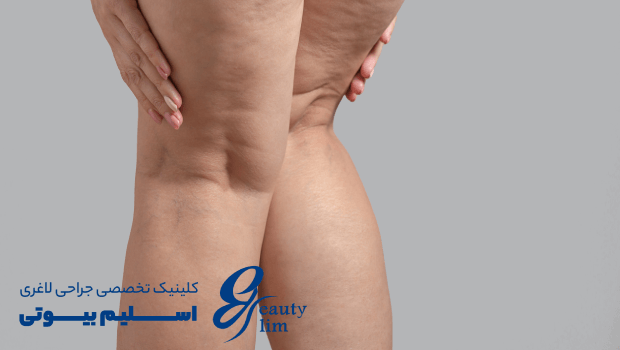 دلایل درد پا بعد از عمل اسلیو معده