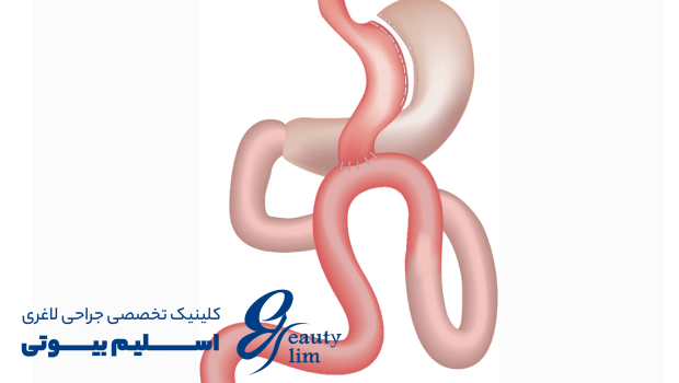 تفاوت بای پس امگا و مینی بای پس