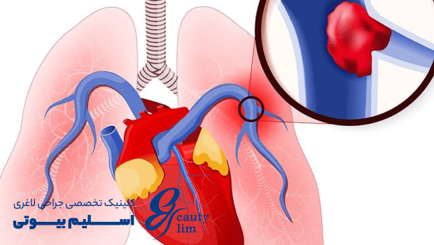 خطر آمبولی تا چند روز بعد از عمل است