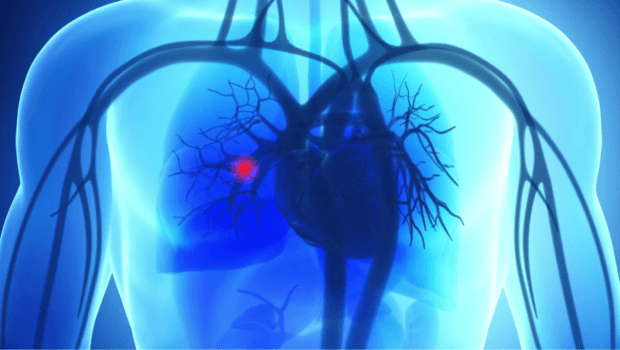 پیشگیری از آمبولی بعد از عمل