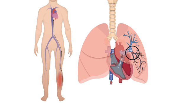 آمبولی بعد از عمل بای پس