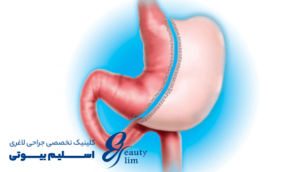 بهترین جراح اسلیو معده در کرج