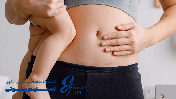 ابدومینوپلاستی همزمان با سزارین