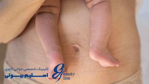 ابدومینوپلاستی همراه با سزارین