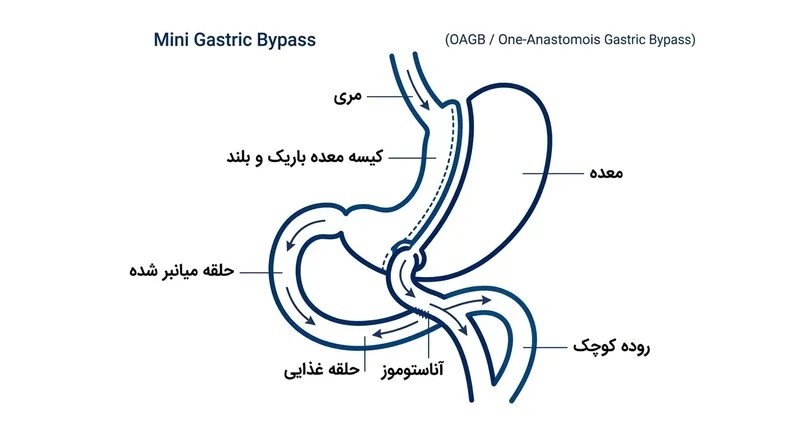 اناتومی-مینی-بای-پس-معده