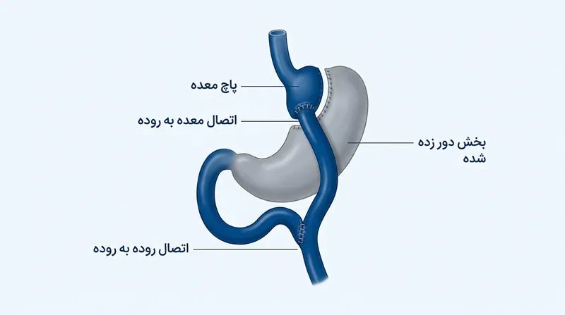 نحوه انجام عمل بای پس معده کلاسیک به روش لاپاروسکوپی